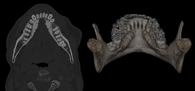 20200208-01-mandibular-tori.jpg