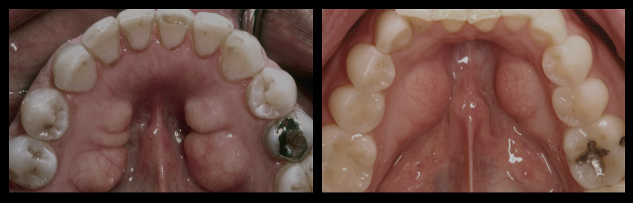 mandibular torus