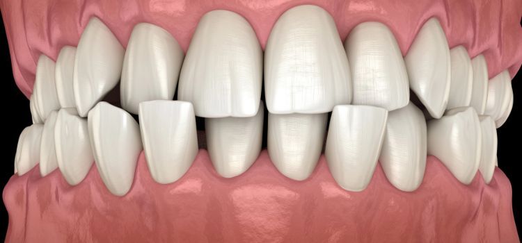 Anterior crossbite dental occlusion ( Malocclusion of teeth ). Medically accurate tooth 3D illustration Anterior crossbite dental occlusion ( Malocclusion of teeth ). Medically accurate tooth 3D illustration