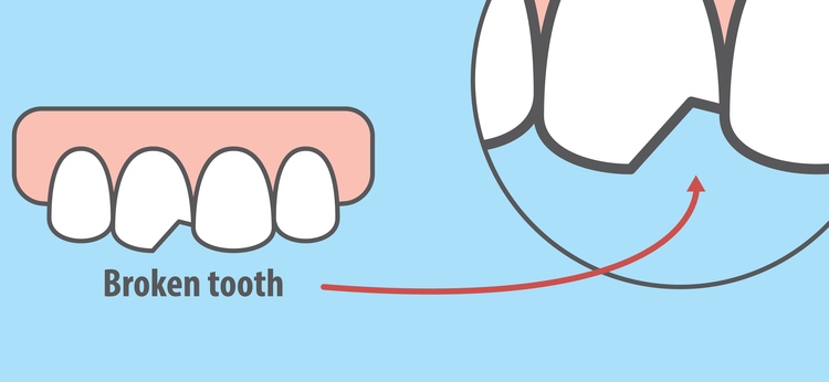 broken tooth