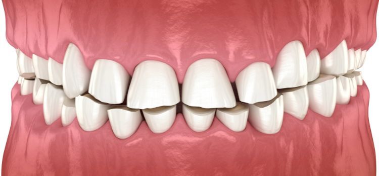 Why Are My Teeth So Short