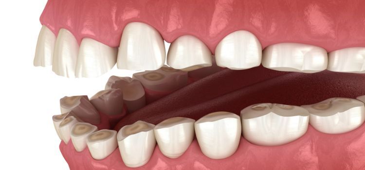 bruxism tooth enamel