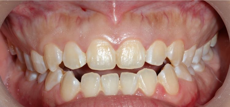 Can a Night Guard Really Cause an Open Bite Can a Night Guard Really Cause an Open Bite