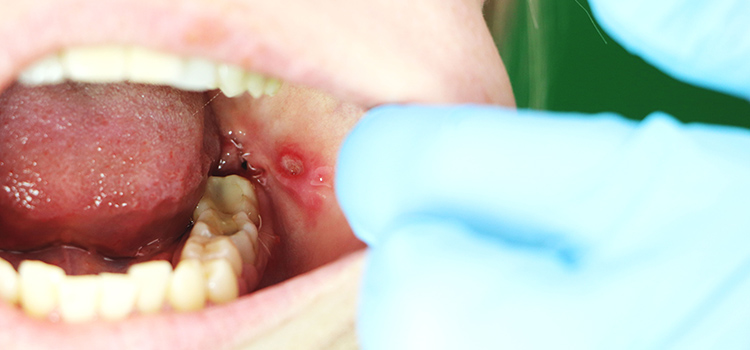 can bruxism cause mouth ulcers