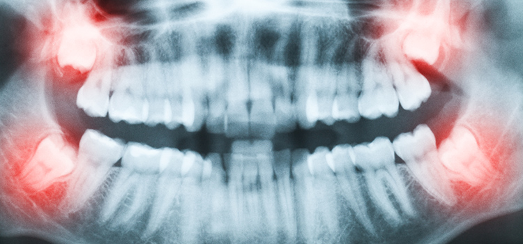Can Wisdom Teeth Removal Cause Teeth Grinding 