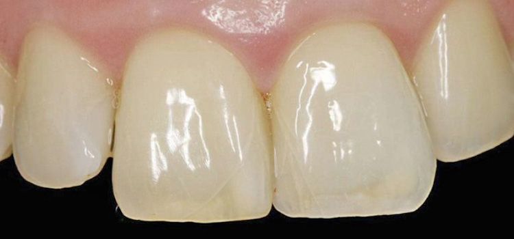 Craze lines in teeth