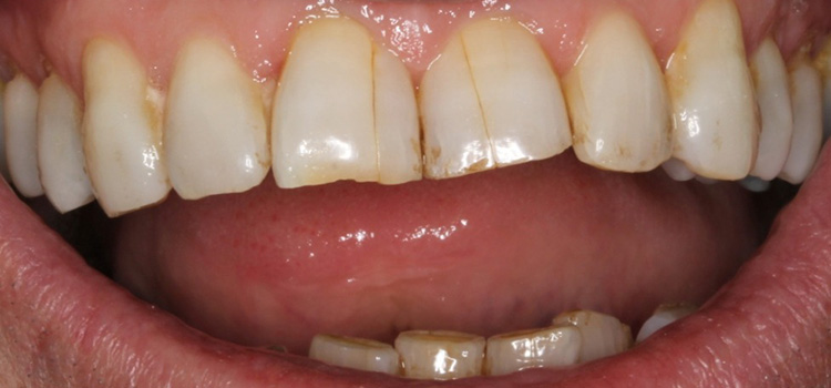 Craze Lines on Front teeth