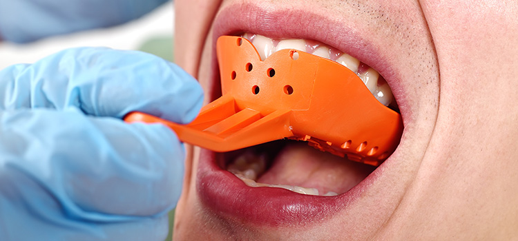 dental impressions without gagging