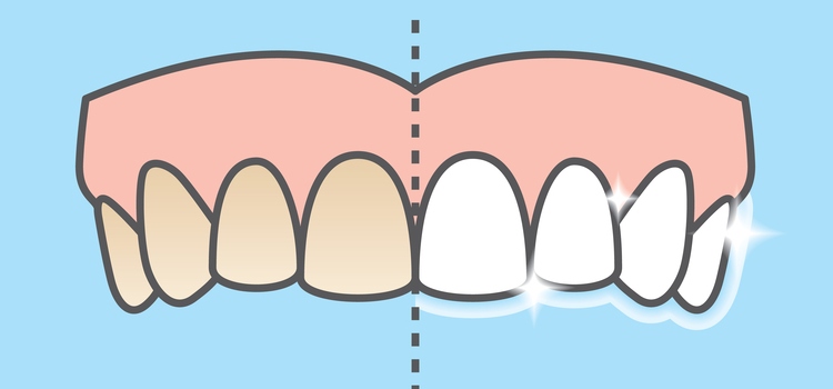 discolored vs. healthy teeth