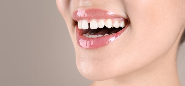 Do Tooth Gaps Matter