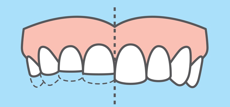 flat vs. healthy teeth