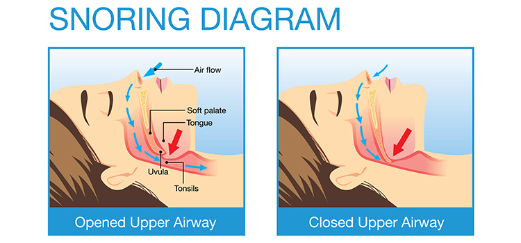 How to stop Snoring and Teeth Grinding