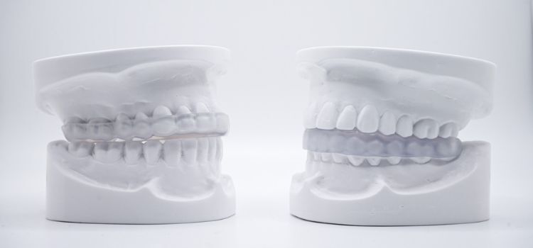 Dental models with upper and lower night guards shown from the front