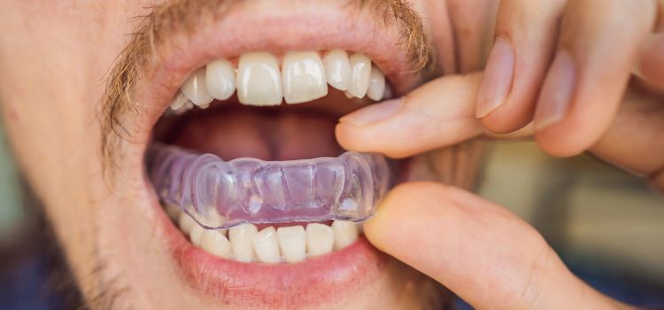 Man placing a custom night guard over his teeth to prevent damage from nighttime grinding.