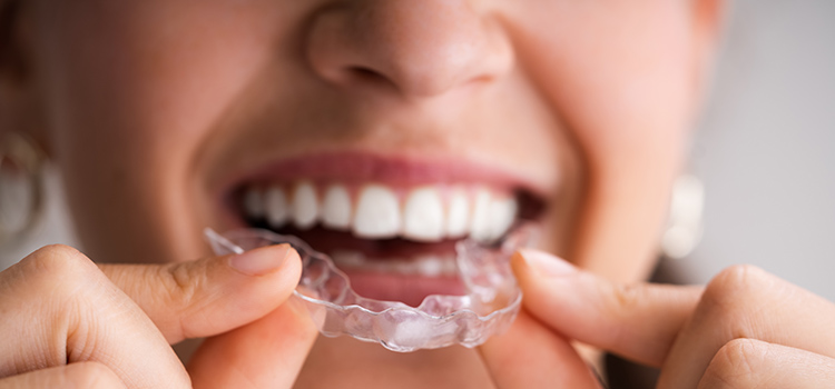 mouth guard for bruxism