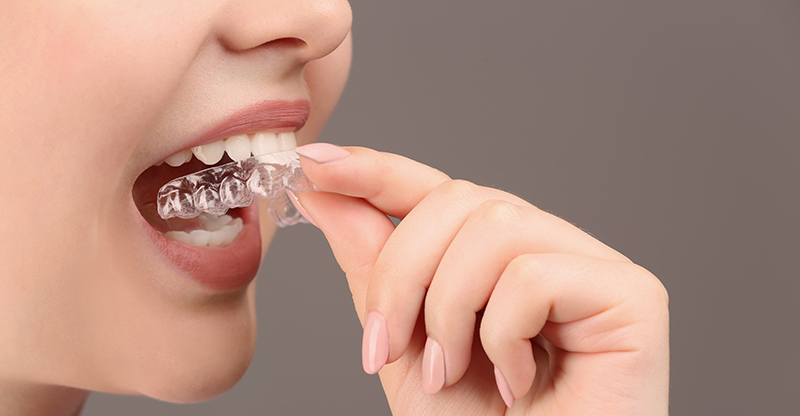 Mouth Guard for Bruxism