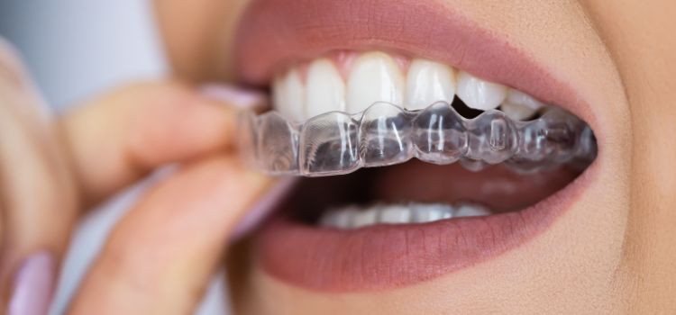 Close-up of a person inserting a clear night guard over their upper teeth.