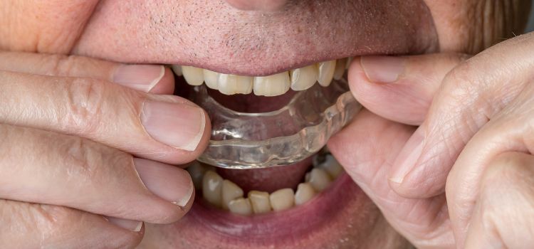 Night Guard Staining Teeth