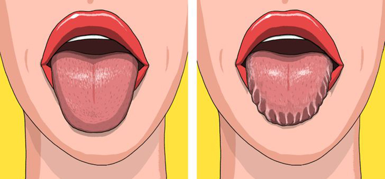 scalloped tongue causes 