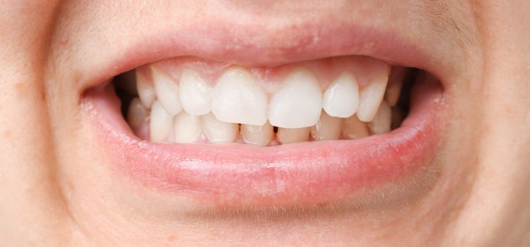 shifting teeth due to night guard