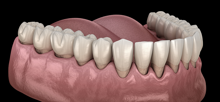 teeth grinding and gum recession