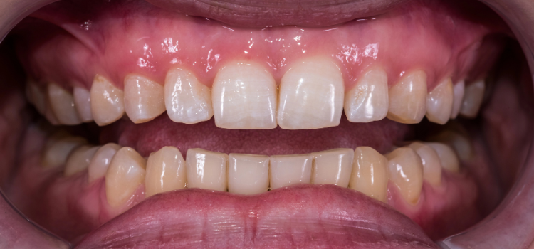 Front teeth with visible flat, shiny wear facets from tooth grinding and clenching