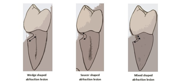 tooth abfraction lesion