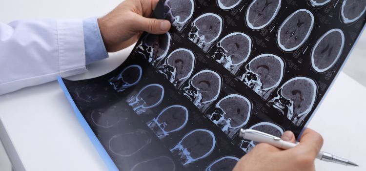 What Causes Teeth Grinding in MS Patients