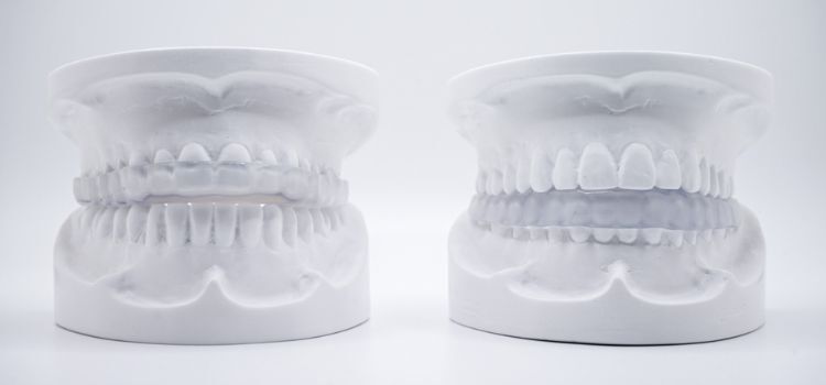 Frontal view of a dental model wearing a clear night guard on lower teeth