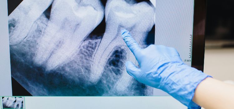 An image of a dental professional pointing at an x-ray of tooth cavity.